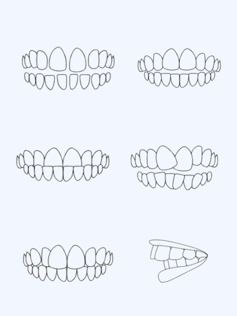 Si les dents du bonheur peuvent parfois avoir un certain charme, toute sorte de malposition dentaire peut entrainer différents maux à moyen et long terme. Vous avez régulièrement des maux de tête ou des douleurs musculaires ? Vos dents se déchaussent ou vous souffrez d’une hyper-sensibilité des dents ? Aligner vos dents pourrait alors être la solution qui changera réellement votre quotidien et bien sûr, votre sourire !
