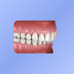 Supraclusion dentaire