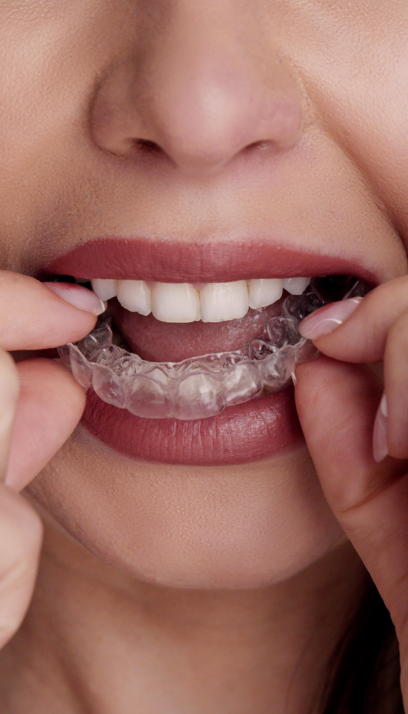 Traitements d'orthodontie par aligneurs invisibles Aligneurs Français