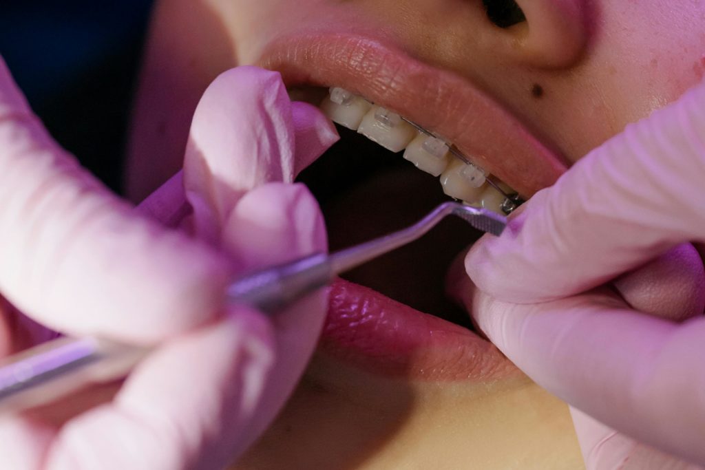 appareil dentaire classique pour corriger la malocclusion dentaire