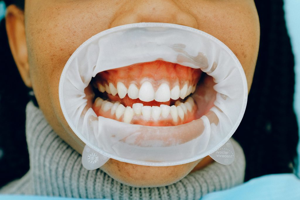 aligner ses dents n’est pas qu’une question esthétique