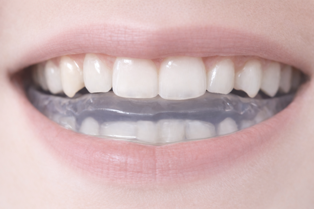 Patient portant une gouttière de bruxisme transparente sur l’arcade supérieure