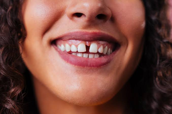 Meta description : Le diastème dentaire désigne un espace entre deux dents, souvent appelé dents du bonheur. Causes, risques, traitements et correction par aligneurs invisibles.