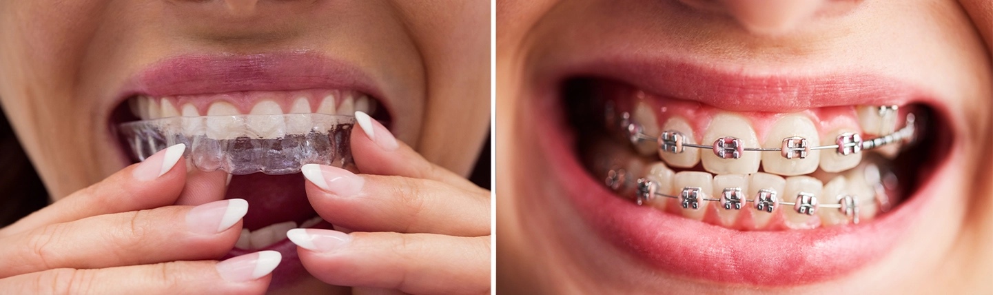 Aligneurs transparents et bagues métalliques : comparaison de deux traitements orthodontiques