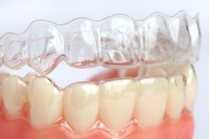 Aligneurs à domicile aligneurs français