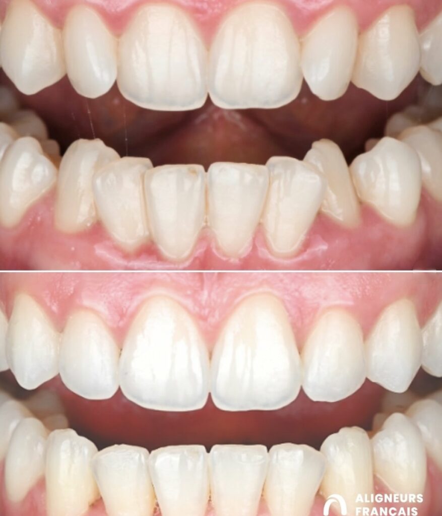 Dents avant et après traitement par aligneurs, cas du Dr Tom Truong